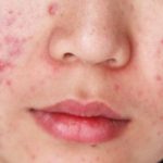 Kondisi Wajah Berjerawat Yang Membuat Tidak Percaya Diri