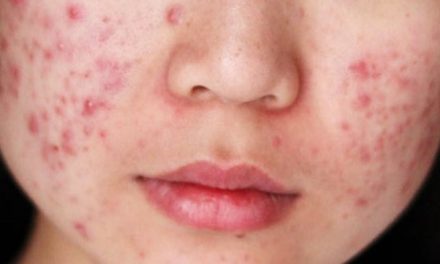 Kondisi Wajah Berjerawat Yang Membuat Tidak Percaya Diri