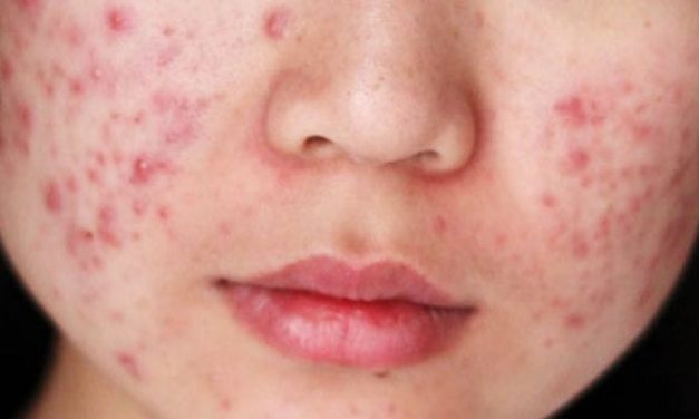 Kondisi Wajah Berjerawat Yang Membuat Tidak Percaya Diri
