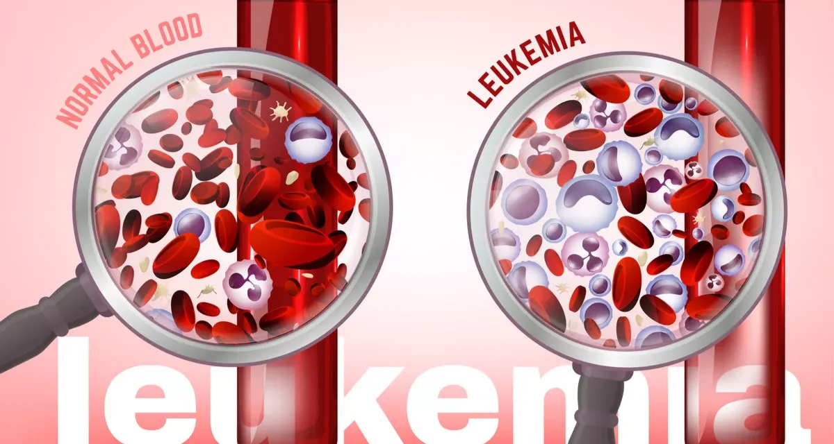 Penyakit Langka Kanker Darah Atau Leukemia