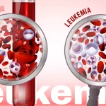 Penyakit Langka Kanker Darah Atau Leukemia
