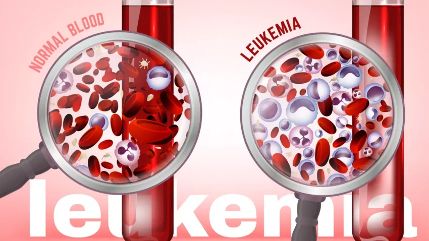 Penyakit Langka Kanker Darah Atau Leukemia