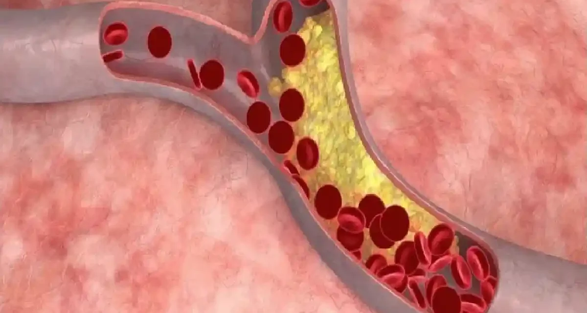 Kondisi Medis Stroke Akibat Aliran Darah Terganggu