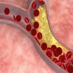Kondisi Medis Stroke Akibat Aliran Darah Terganggu
