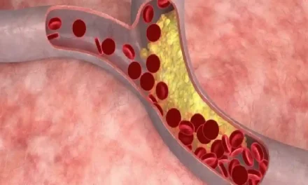 Kondisi Medis Stroke Akibat Aliran Darah Terganggu