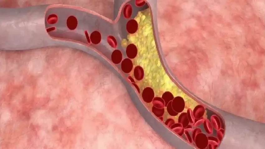 Kondisi Medis Stroke Akibat Aliran Darah Terganggu