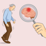 Penyerangan Otak Pada Sebuah Penyakit Alzheimer