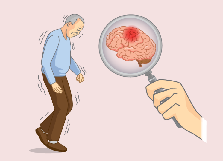 Penyerangan Otak Pada Sebuah Penyakit Alzheimer