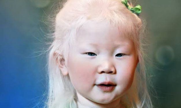 Kondisi Genetik Albino Pada Tubuh Seseorang