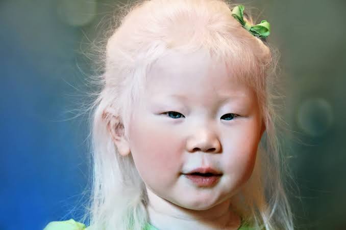 Kondisi Genetik Albino Pada Tubuh Seseorang