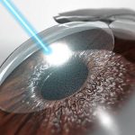 Pembedahan Mata Dari Beberapa Penyakit Dengan Lasik