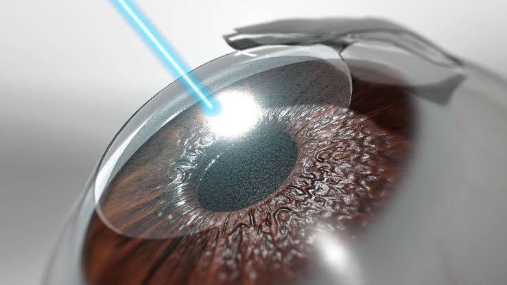 Pembedahan Mata Dari Beberapa Penyakit Dengan Lasik